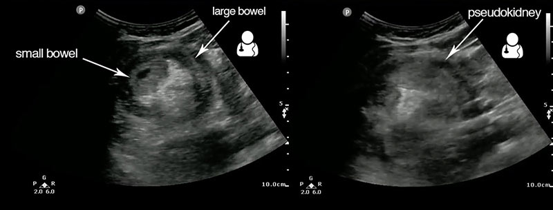 intussusception target sign