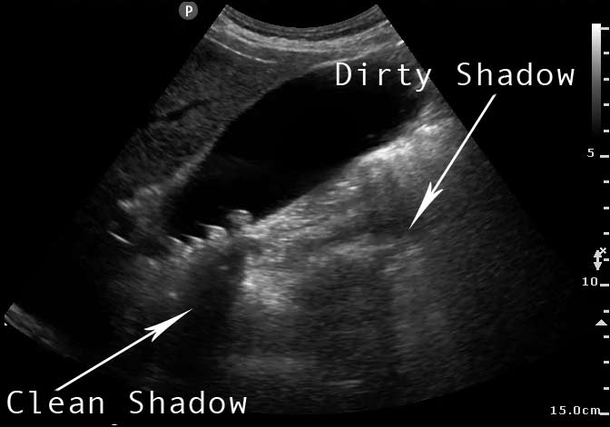 Gallstone with wall-echo-shadow sign. Ultrasound shows a typical