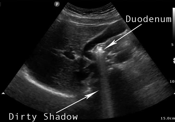 bowel gas artifact meaning