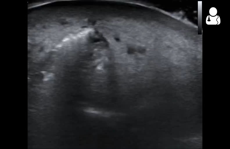 Ultrasound Diagnosis of Necrotizing Soft Tissue Infections – Core EM